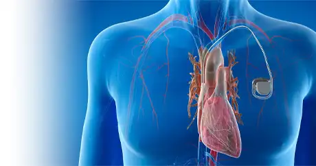 pacemaker implantation Surgery in Delhi NCR 